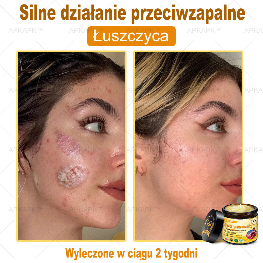 ΑPΚΑPK® Jad Pszczoły Kompleksowy Krem🔥🔥pomaga w leczeniu problemów skórnych, takich jak: zmarszczki, blizny, plamy pigmentacyjne, rozstępy, trądzik, łuszczyca, egzema, zmiany skórne, podrażnienia, stany zapalne i inne problemy skórne🔥