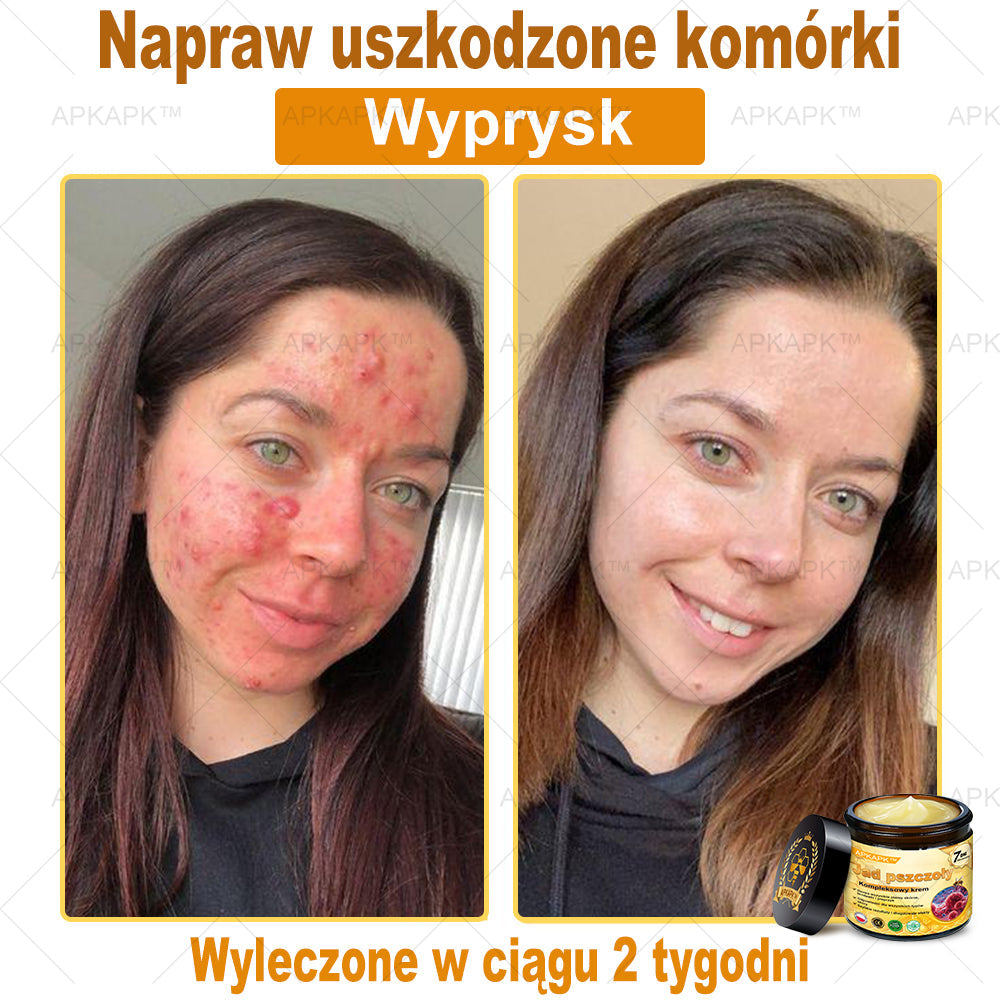 ΑPΚΑPK® Jad Pszczoły Kompleksowy Krem🔥🔥pomaga w leczeniu problemów skórnych, takich jak: zmarszczki, blizny, plamy pigmentacyjne, rozstępy, trądzik, łuszczyca, egzema, zmiany skórne, podrażnienia, stany zapalne i inne problemy skórne🔥