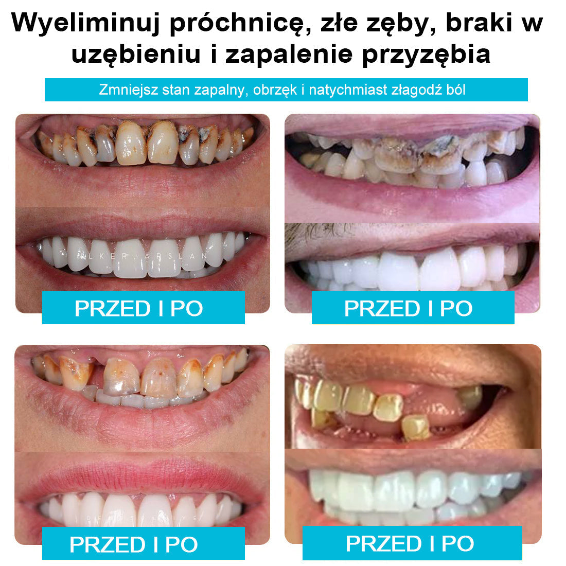 Zostało tylko 5 ostatnich pakietów prezentowych z 50% zniżką! Odzyskaj wiarę w swój uśmiech, jeśli przegapisz tę szansę na zakup, będziesz musiał poczekać do przyszłego roku!